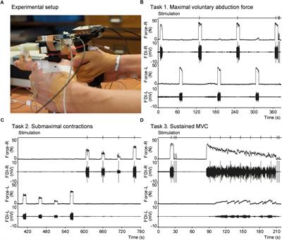 Self-Reported Fatigue After Mild Traumatic Brain Injury Is Not Associated With Performance Fatigability During a Sustained Maximal Contraction